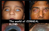 Corneal blindness at 12 million in India
